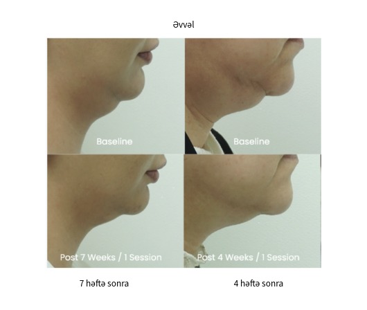 Classys Clatuu Alpha